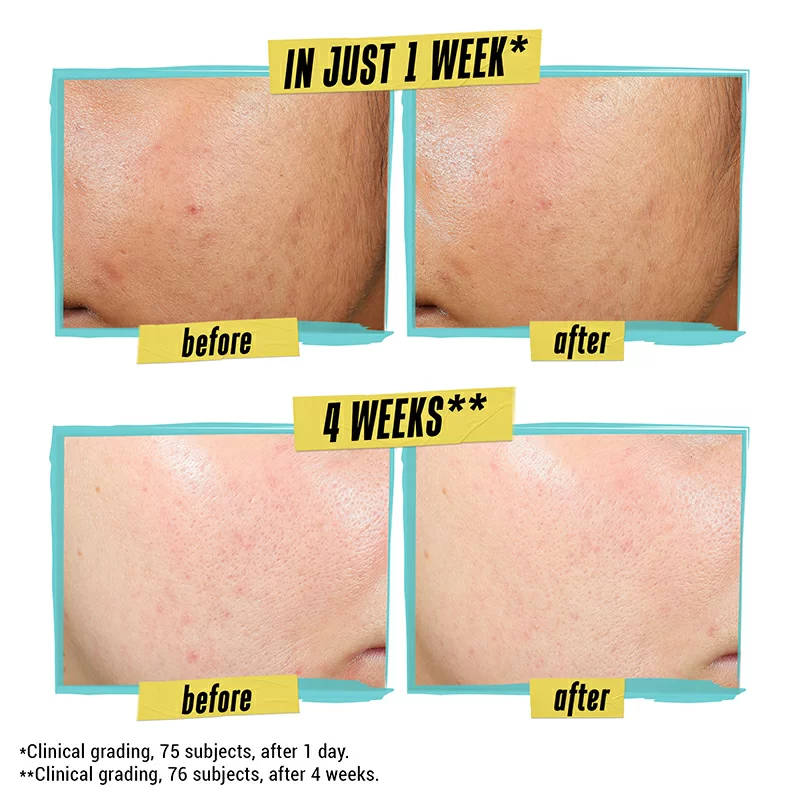 Expertly Clear Blemish-Treating & Preventing Lotion